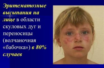 krasnaya sistemnaya volchanka u detej