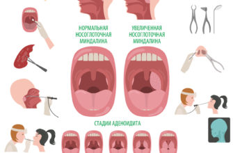 lechenie ostrogo adenoidita u detej
