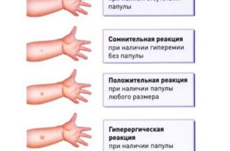 mantu privivka novaya