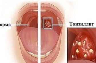 ostryj tonzillit u rebenka simptomy
