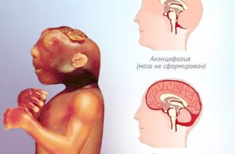 patologiya golovnogo mozga u ploda