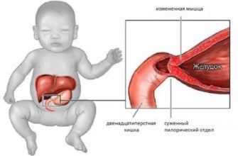 pilorostenoz u novorozhdennyh simptomy