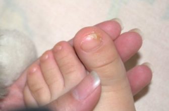 pochemu u detej sloyatsya nogti na nogah