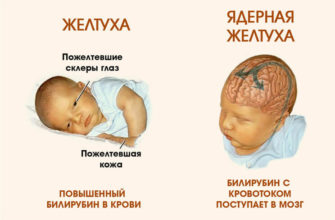 prichina zheltuhi u novorozhdennyh