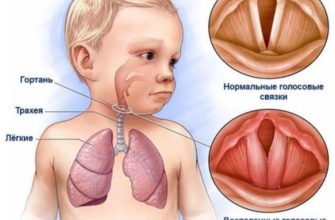 traheobronhit u rebenka