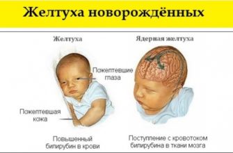 zheltuha u novorozhdennyh prichiny i lechenie