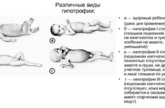 Ребенок на грудном вскармливании плохо набирает вес